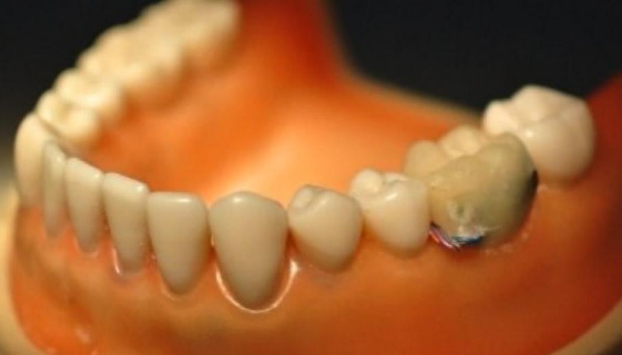 Tooth Sensor Monitors Your Oral Health