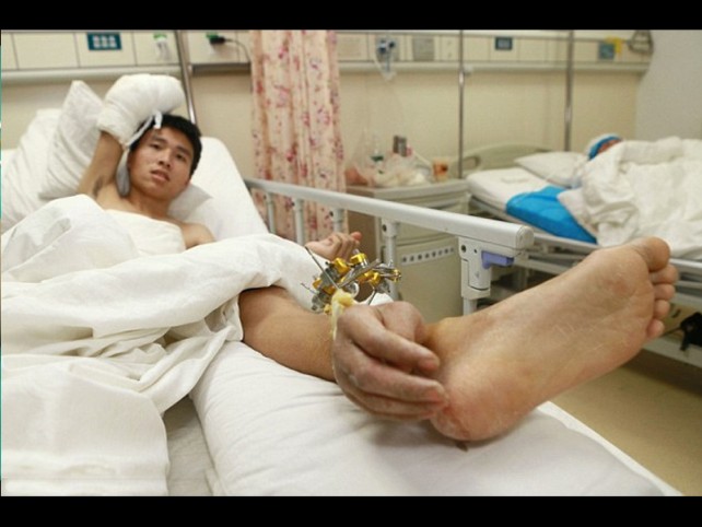 Doctors Attempt to Save Man’s Severed Hand by Attaching it to His Ankle