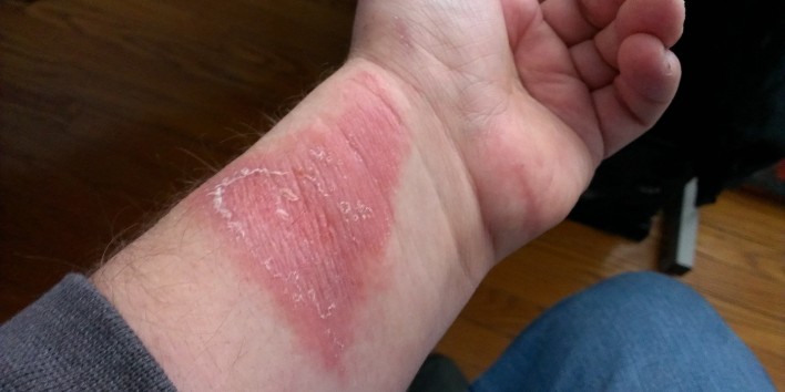 Fitbit Force Allergic Reaction