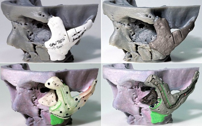 Pioneering 3D Printing Reshapes Patient’s Face