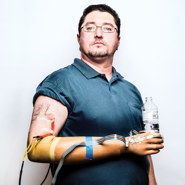 Feeling Restored in Bionic Arm Patient