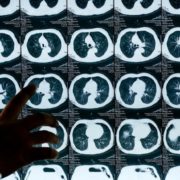 Artificial Intelligence System Detects Regularly Missed Cancer Tumors with 95% Efficiency 