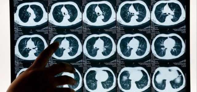 Artificial Intelligence System Detects Regularly Missed Cancer Tumors with 95% Efficiency 